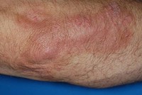 Po ošetření lupénky